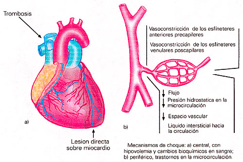 fisiopatología del shock hipovolémico